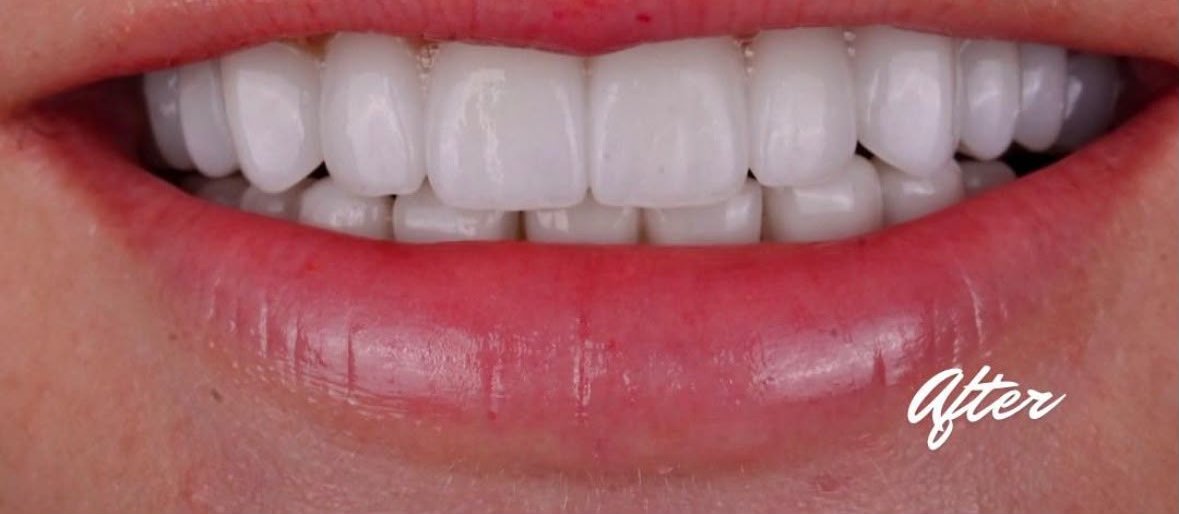 Caz fațete și coroane Bel-Dent Baia Mare, margine gingivală sănătoasă după tratament