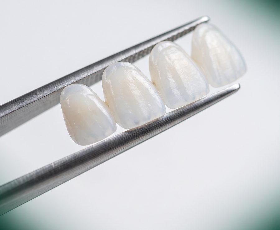 Fațete dentare din ceramică emax, estetică dentară la Bel-Dent Baia Mare