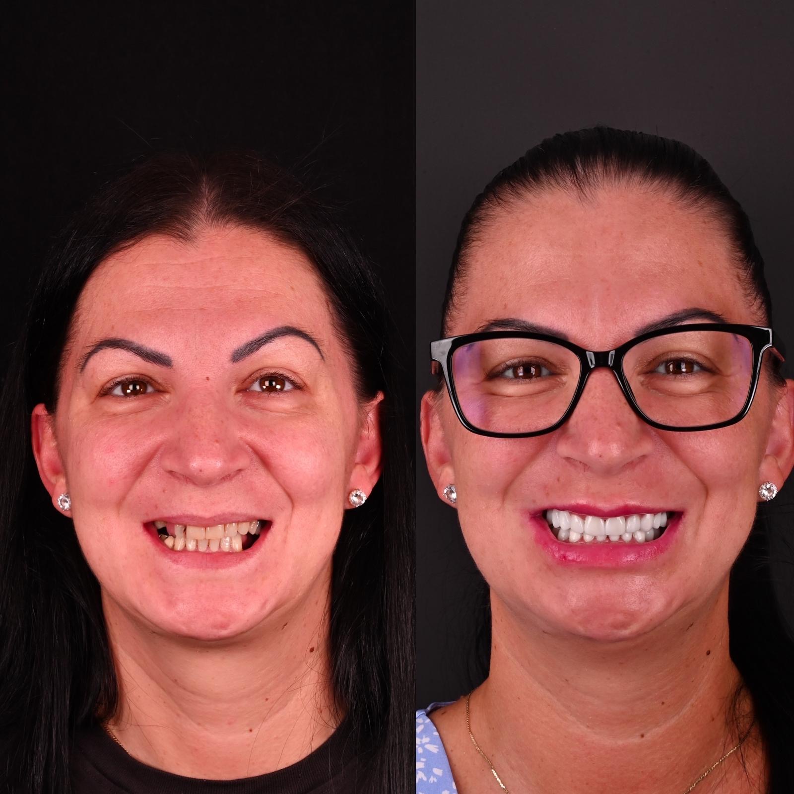 Gutieră dentară personalizată realizată pentru un pacient Bel-Dent