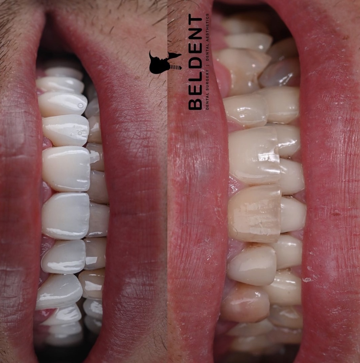 Rezultat de tratament dentar din portofoliul Bel-Dent Baia Mare