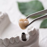 Implant dentar Baia Mare